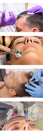 Meso-Needling-Behandlung