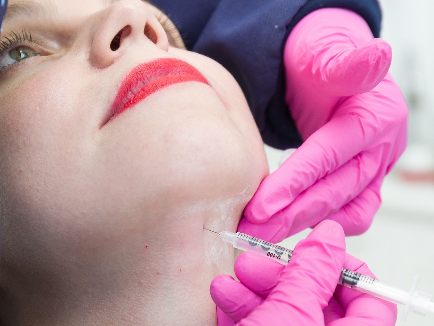 Injection lipolysis – chin